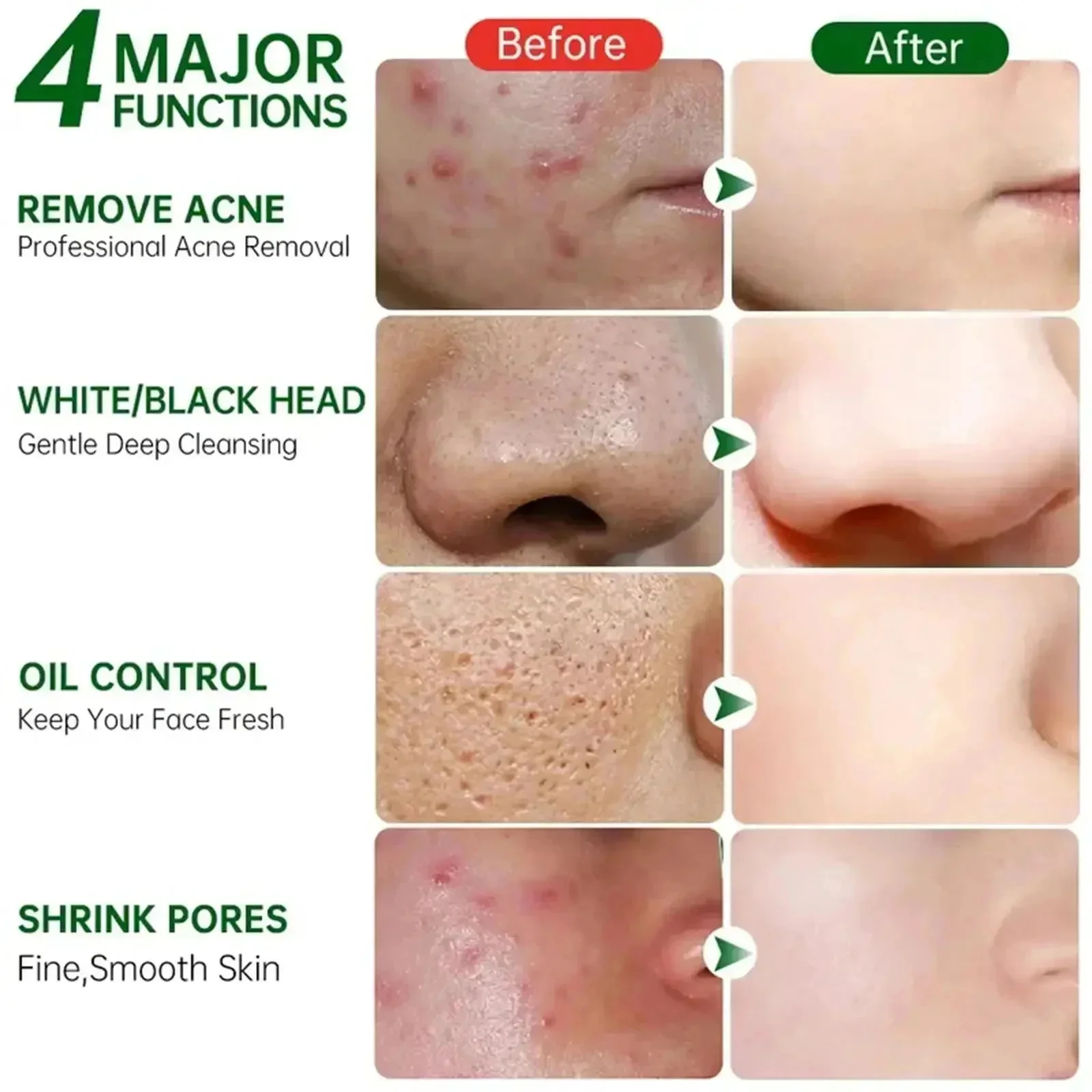 Salicylzuur Porie Clearing Cre - Salicylic Acid Blackhead Remover recensie en prijs