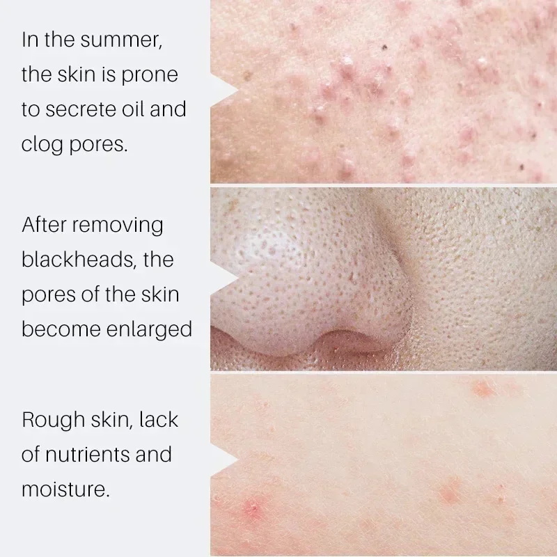 Salicylzuur Poriënverkleinend  - Salicylic Acid Blackhead Remover recensie en prijs