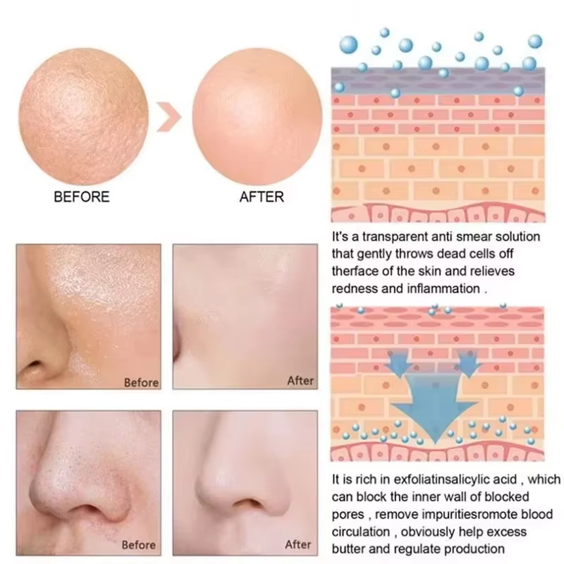 Salicylzuur Poriënverkleinend  - Salicylic Acid Blackhead Remover recensie en prijs