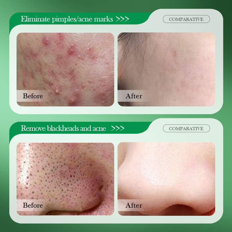 Salicylzuur Acne Behandeling C - Salicylic Acid Blackhead Remover recensie en prijs